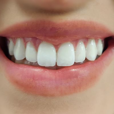 Dental Bonding - Smile 3 before